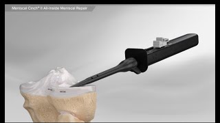 Meniscal Cinch™ II AllInside Meniscal Repair [upl. by Allina]