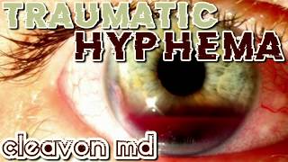 Cleavon MD  Traumatic Hyphema [upl. by Dupuy]