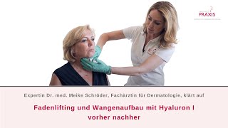 Fadenlifting und Wangenaufbau mit Hyaluron I Vorher Nachher [upl. by Noreg]