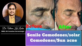 Senile Comedonessolar ComedonesPimples or blackheads in old ageacne treatmentblackheads removal [upl. by Anaer]