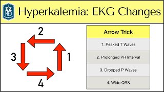 Hyperkalemia ECG Changes EASY TRICK Mechanism Explained [upl. by Lokkin]