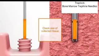 TrapLock Trap lock Bone Marrow Trephine Biopsy Needle Method of use [upl. by Herminia]