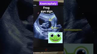 Anencephaly frog eye sign usgantenatalradiologypregnantgynecologyradiographysonography [upl. by Dahlia]