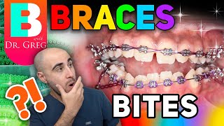 Braces Overbite Overjet Underbite Crossbite amp Open Bite Explained [upl. by Aiken]