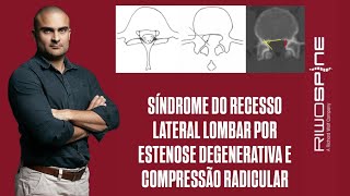 09112024  IL L5S1  SÍNDROME DO RECESSO LATERAL POR HÉRNIA DISCAL CALCIFICADA EM PACIENTE OBESO [upl. by Alim585]