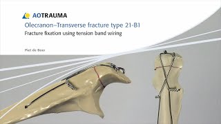 Olecranon  Fracture Fixation Using Tension Band Wiring [upl. by Sherard]