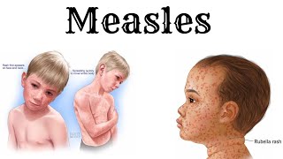 Everything about MEASLES in detail and simple [upl. by Reisman220]