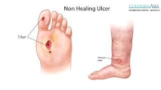 What are types of non healing ulcers amp How should a diabetic foot ulcer be treated [upl. by Gorlin153]