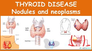 Thyroid Diseases Nodules and Neoplasms [upl. by Mahgirb]