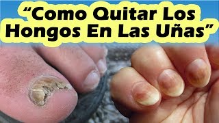 HONGOS EN LAS UÑAS TRATAMIENTO Como Eliminar Los Hongos De Las Uñas Delos Pies o De Las Manos [upl. by Weidar221]