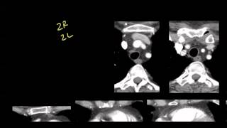 Mediastinal anatomy and nodal stations on CT [upl. by Fortunia]