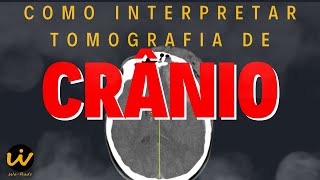 Como Interpretar uma TOMOGRAFIA COMPUTADORIZADA de CRÂNIO [upl. by Atiruam]