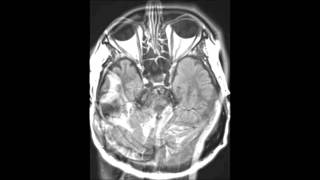 TransverseSigmoid Sinus Venous Thrombosis [upl. by Fulcher875]