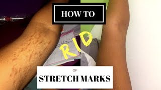 HOW TO GET RID OF STRETCH MARKS amp SCARS FAST  RealWednesdays [upl. by Ees]