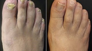 Toenail Fungus Treatment Listerine Home Cure [upl. by Nuavahs629]