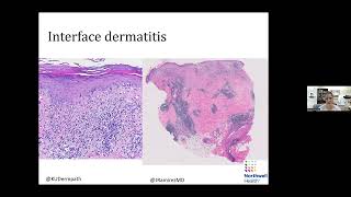 Global Dermatology Talks 11272023  Silvija Gottesman [upl. by Cheston147]