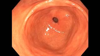 LAA Reflux Esophagitis Multiple Erythematous gastritis Angiodysplasia on antrum [upl. by Nitsoj]