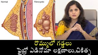 Fibroadenosis of Breast in Women Causes amp Treatmentరొమ్ములో గడ్డలు ఫైబ్రో ఎడినోమా లక్షణాలుచికిత్స [upl. by Nelyaw140]