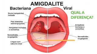 DOENÇAS DA AMIGDALA AMIGDALITE AGUDA VIRAL OU AMIGDALITE BACTERIANA Otorrino em Curitiba [upl. by Critchfield]