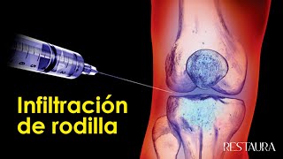 Infiltración de rodilla  Todo lo que necesitas saber [upl. by Nimsaj]