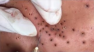 Top of Blackhead Extraction Video 2020  Best Blackhead Removal Videos 2020 [upl. by Leonardi257]