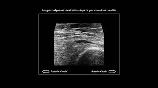 Pes anserinus bursitis on knee ultrasound [upl. by Mireille756]