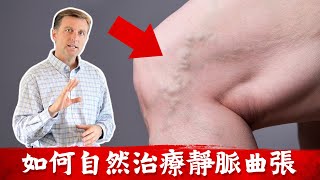 靜脈曲張簡單自然療法柏格醫生 Dr Berg [upl. by Lupita]