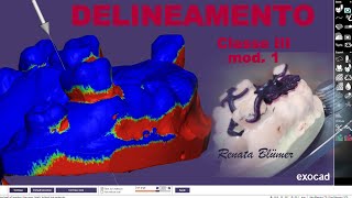 DELIENAMENTO VIRTUAL  CLASSE III  MOD 1  AULAS ONLINE PPR DIGITAL  PLATAFORMA EXOCAD [upl. by Dickey702]