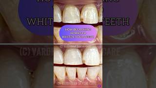 How Bleaching Works To Written Your Teeth [upl. by Ly]