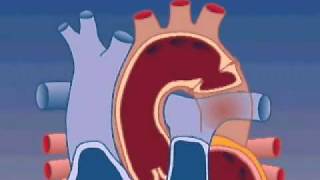 Aortic Dissection and Cardiac Tamponade [upl. by Ggerg]