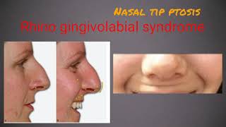 Nasal tip lift and nasal flare correction by botox [upl. by Bega]