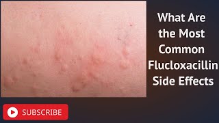 What Are the Most Common Flucloxacillin Side Effects [upl. by Rivi]