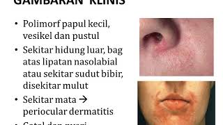 DERMATITIS PERIORAL  Materi Kedokteran  Dermatologi [upl. by Poirer563]