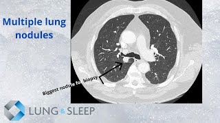 GE Healthcare XrayGE Healthcares VolumeRAD Lung Nodule Detection  GE Healthcare [upl. by Marks]