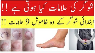 Diabetes and Its Common Symptoms Sugar Ki Alamat Kya Hoti Hai  Dr Kashif Ali [upl. by Shalne]