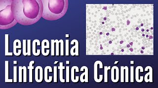 Leucemia Linfocítica Crónica [upl. by Sheya785]