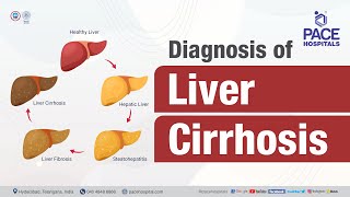 Diagnosis of Liver Cirrhosis  PACE Hospitals shortvideo livercirrhosis [upl. by Gut]