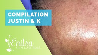 Compilation of “Justin” and “K” Blackheads Extractions [upl. by Vladamir]