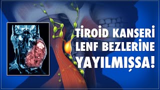 Tiroid Kanseri Lenf Bezlerine Yayılmışsa [upl. by Henderson]