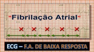 ECG  Eletrocardiograma com Fibrilação Atrial com Baixa Resposta Ventricular [upl. by Rumpf]