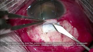 Deep Sclerectomy Glaucoma Surgery  Pearls for Success [upl. by Salohcim]