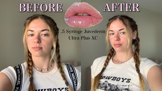 GETTING 05 SYRINGE OF JUVEDERM ULTRA PLUS XC before during amp after [upl. by Balf]