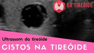 Ultrassom da tireóide  Cisto na tireóide é perigoso  Dr Jônatas Catunda [upl. by Einnahc]