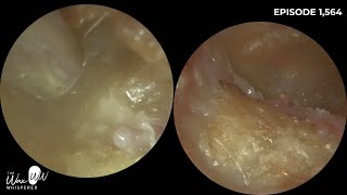 1564  Bilateral Rare Canal Cholesteotoma Patient Waiting 25 Years to be seen by ENT [upl. by Adnilg]