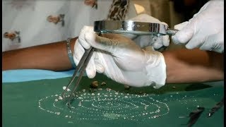 India Seven year old kid got 526 teeth extracted  BBCURDU [upl. by Kahlil566]