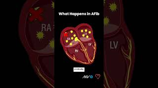 Process of AFib in Your Heart [upl. by Pasol]