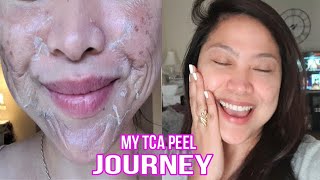 DIY 25 TCA Chemical PeelBEFORE and AFTERSKINCARE POST TREATMENT ROUTINE [upl. by Cullan382]