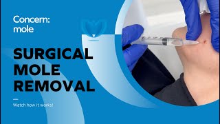 Mole Removal  Safe Surgical Procedure to Remove a Mole Skin Tag Wart  Fast Mole Surgery [upl. by Grizelda]