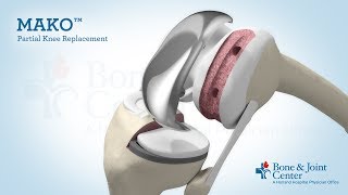 Partial Knee Replacement  Mako Robotic Arm Assisted Surgery Technology [upl. by Sletten]