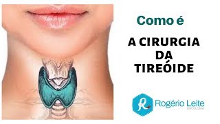 Tireoide Como É A Cirurgia Da Tireoide [upl. by Nnaeus]